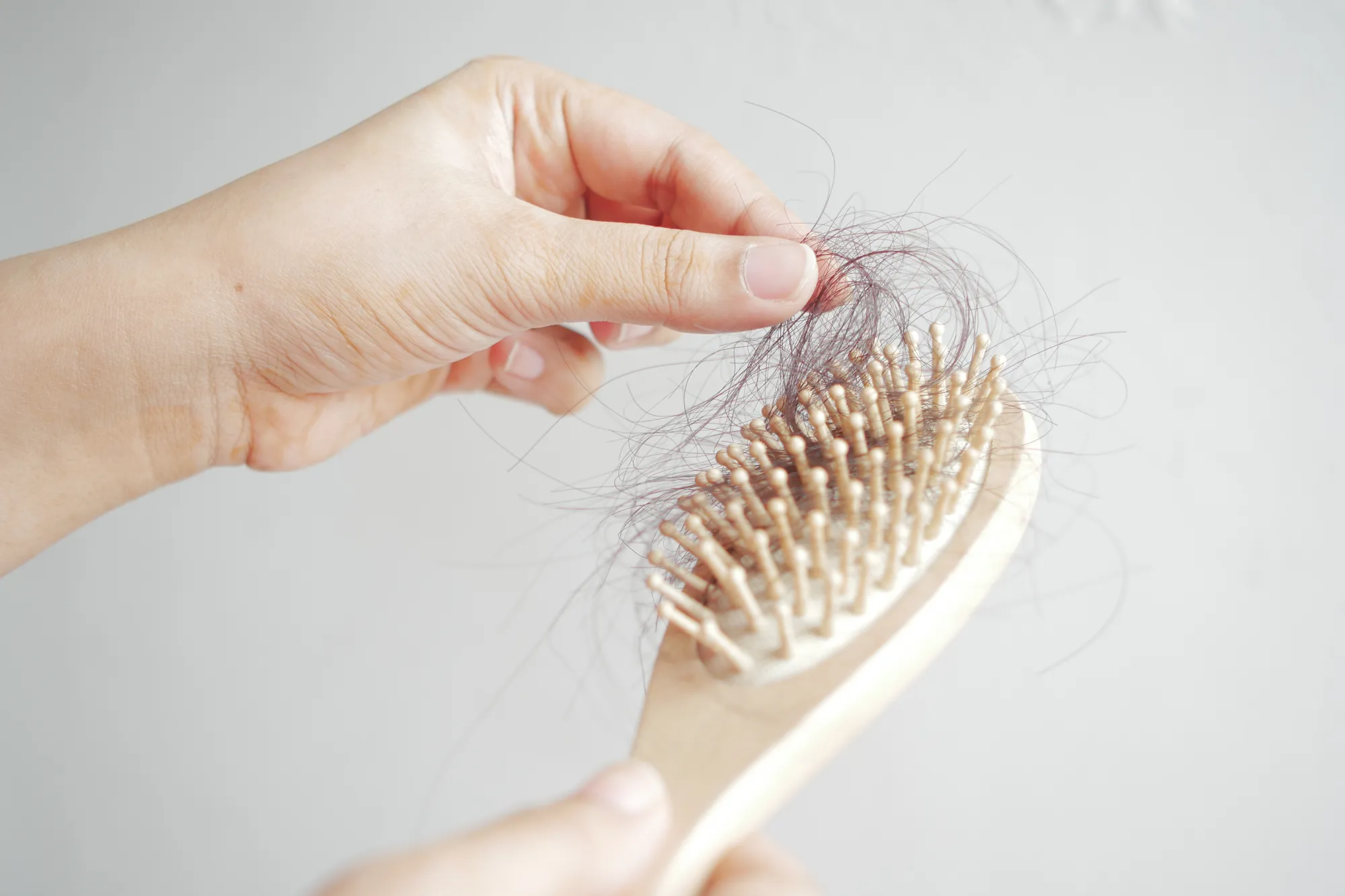 cheveux sur une brosse indiquant la nécessite d'une greffe de cheveux pour femme